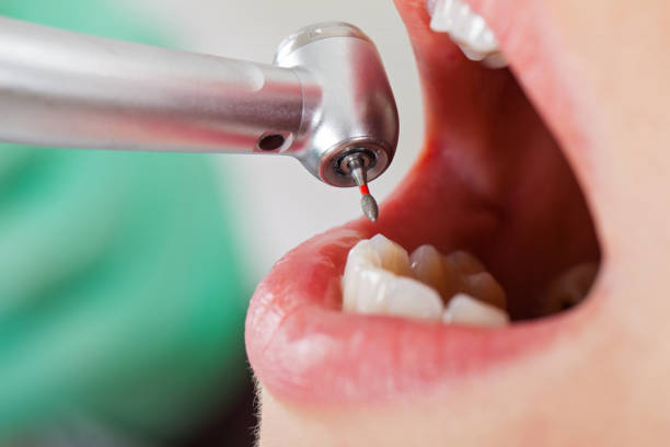Best Emergency Tooth Extraction in Galena Park, TX